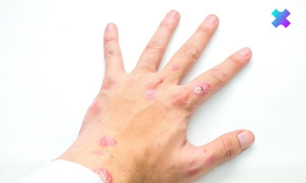 zmiany skórne w łuszczycy