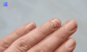 Leczenie grzybicy paznokci u dłoni, skuteczne metody i porady od Nexmed.