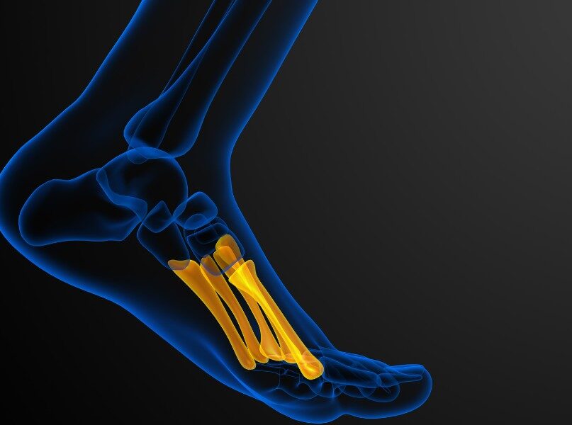 Kości śródstopia – kiedy ból wymaga leczenia?