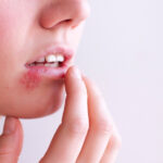 Opryszczka - jak się jej skutecznie pozbyć? opryszczka jak się pozbyć