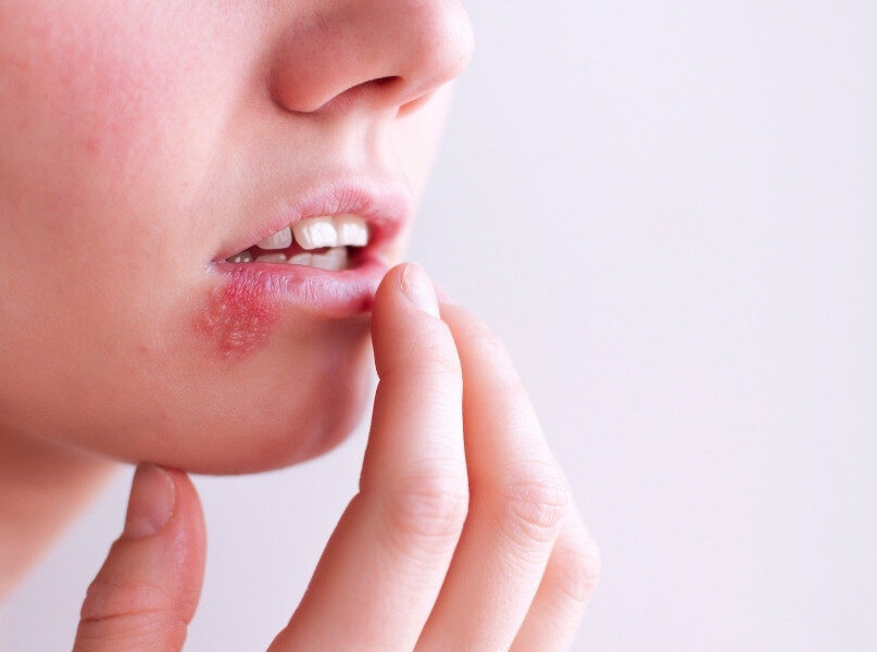 Opryszczka – jak się jej skutecznie pozbyć?