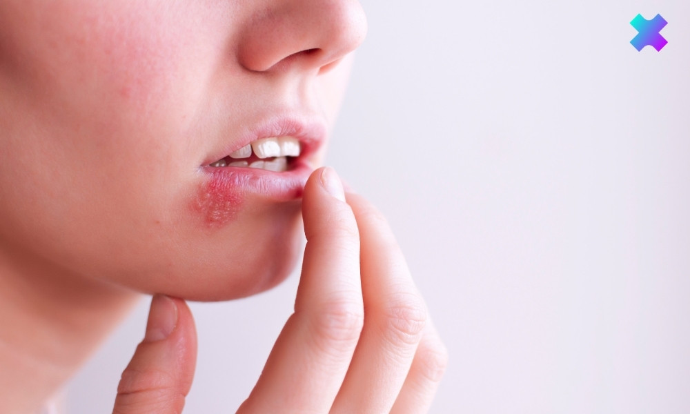 opryszczka jak się pozbyć