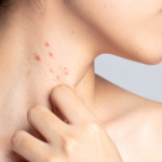 Czerwone plamy na szyi przed wystąpieniem – jak opanować stres? czerwone-plamy-na-szyi