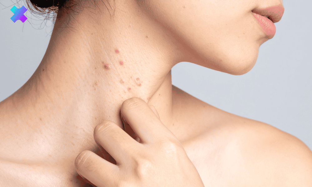 Trądzik na szyi z czerwonymi plamami przed stresem i jego wpływem na skórę.